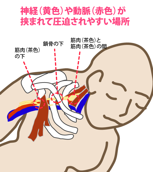 胸郭出口症候群において、血管・神経が圧迫されやすい場所を示した図
