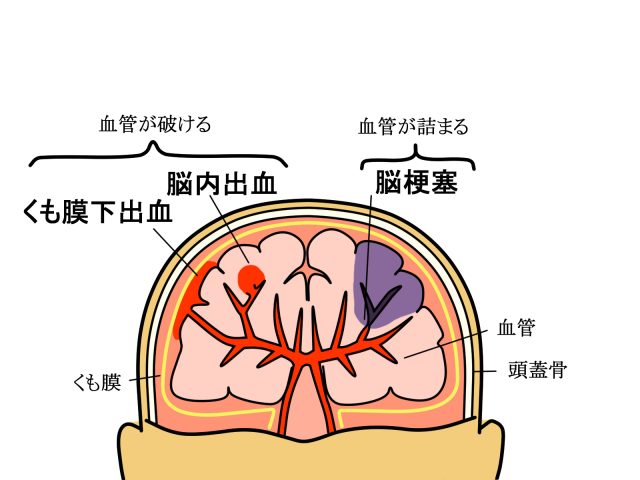 脳卒中の分類